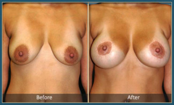 Before and After Breast Lift 5