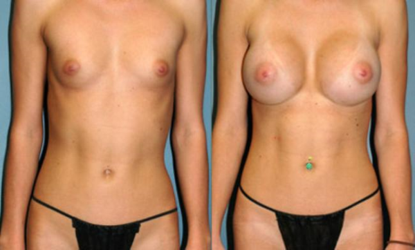 Before and After Breast Augmentation 3