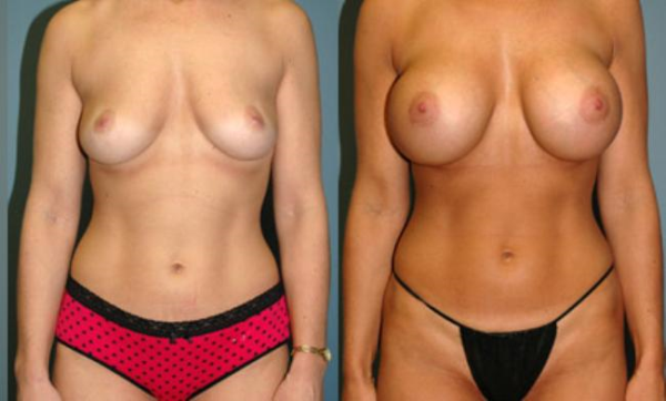 Before and After Breast Augmentation 1
