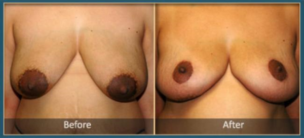 Before and After Breast Reduction 2