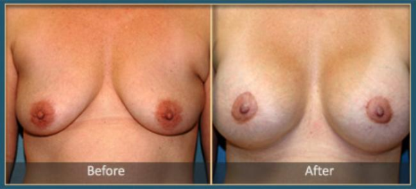 Before and After Breast Reduction 3