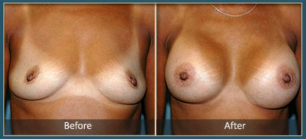 Before and After Breast Augmentation 2