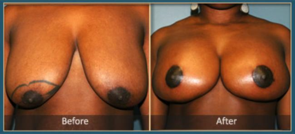 Before and After Breast Lift 2