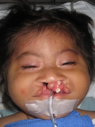 Before and After Cleft Lip