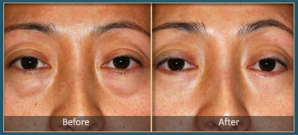 Before and After blepharoplasty 4