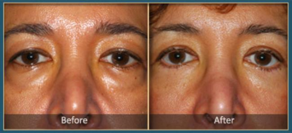 Before and After blepharoplasty 3