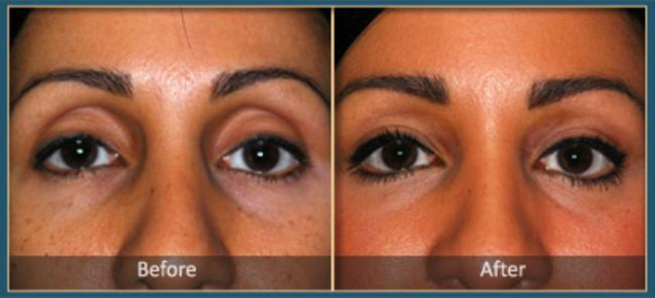 Before and After blepharoplasty 7