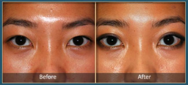 Before and After blepharoplasty 2