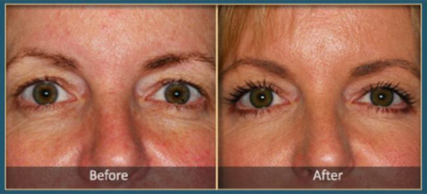Before and After blepharoplasty 1