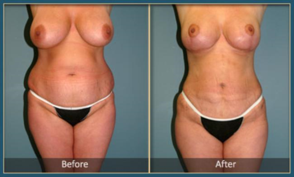 Before and After Liposuction 1