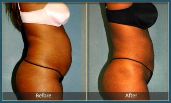 Before and After Liposuction 2