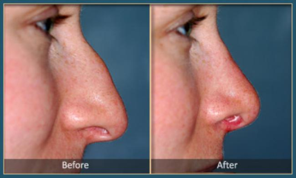 Before and After Rhinoplasty 4