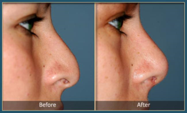 Before and After Rhinoplasty 5