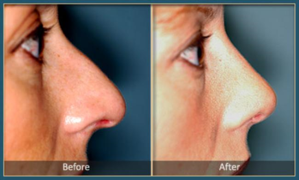 Before and After Rhinoplasty 5