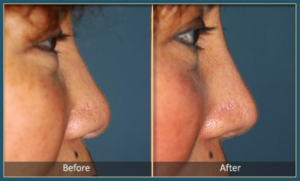 Before and After Rhinoplasty 3