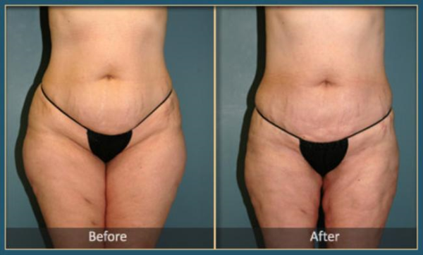 Before and After Liposuction 3
